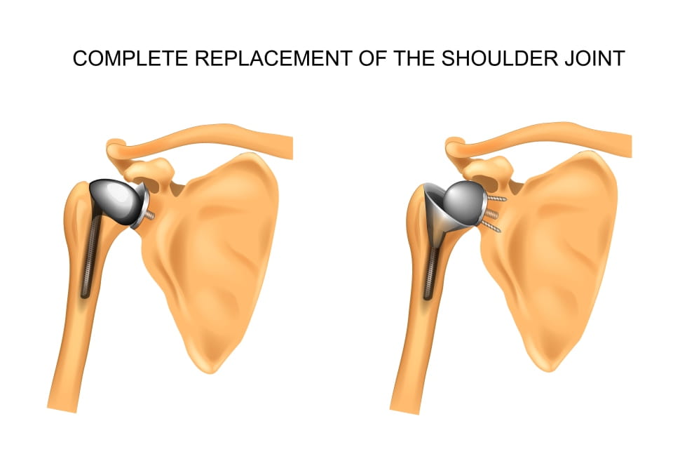 Anatomic and Reverse Shoulder Replacements